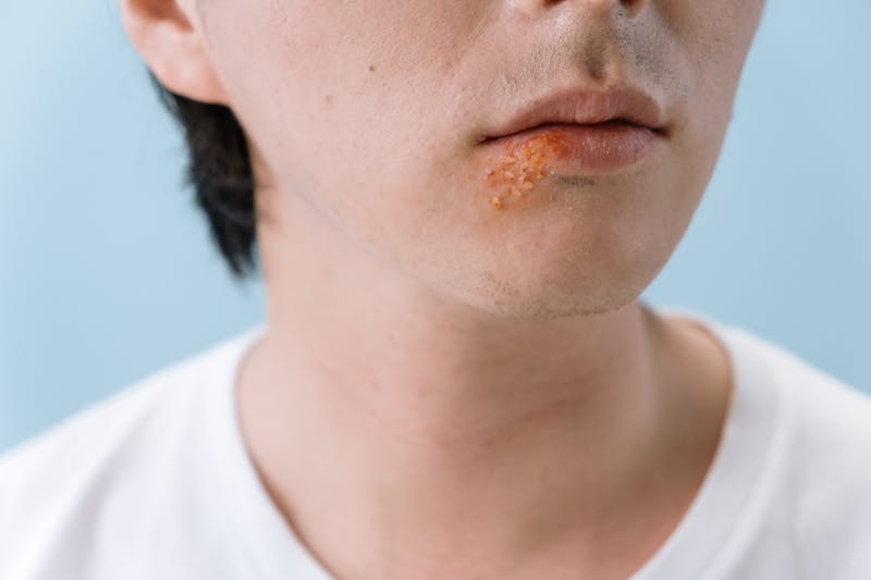 Cold sore (herpes simplex) on a person's lip — typical appearance