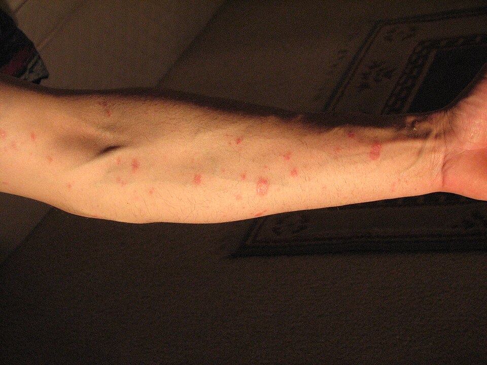 Pityriasis rosea — oval scaly patches on the torso in a Christmas tree distribution pattern
