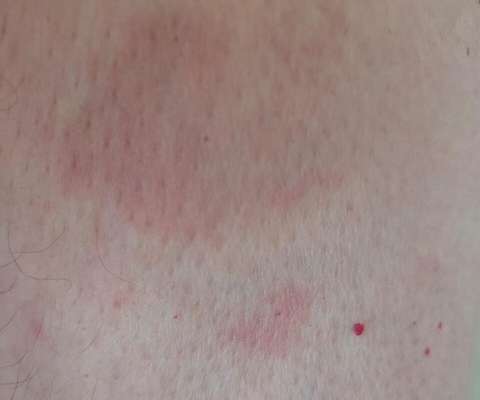 Granuloma annulare — smooth, firm, ring-shaped bumps on the skin that mimic ringworm but lack the scaly texture of a fungal infection