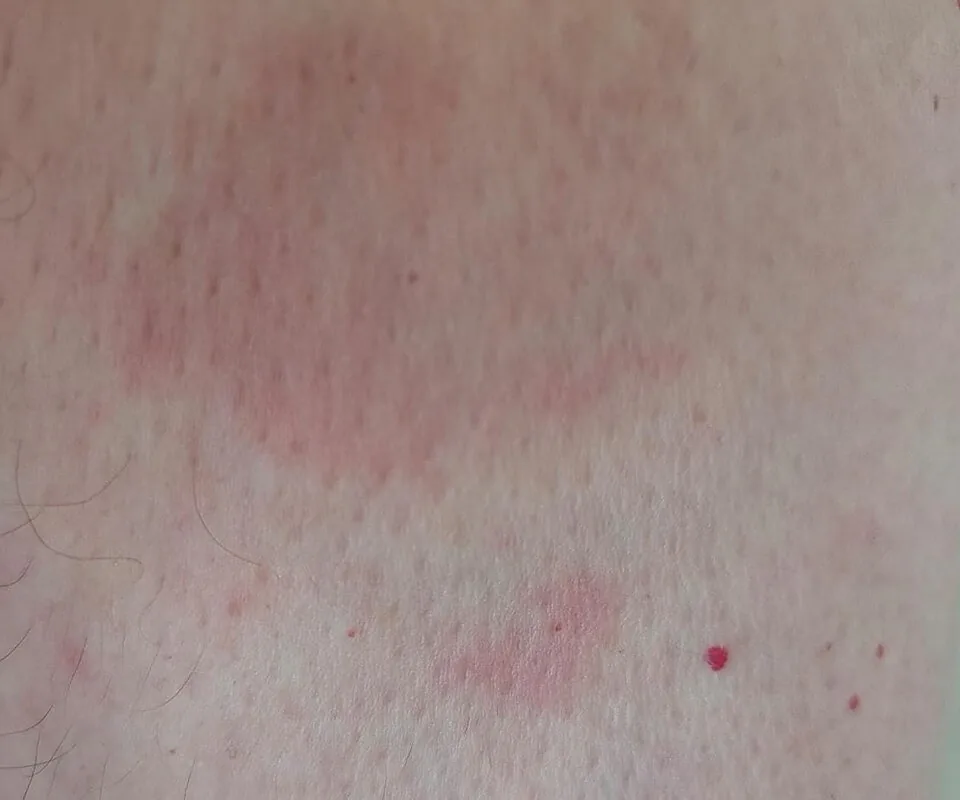 Granuloma annulare — smooth, firm, ring-shaped bumps on the skin that mimic ringworm but lack the scaly texture of a fungal infection