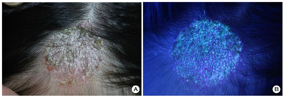 Tinea capitis under normal light (A) showing scaly scalp lesion, and under Wood's lamp (B) showing characteristic blue-green fluorescence of dermatophyte fungal infection