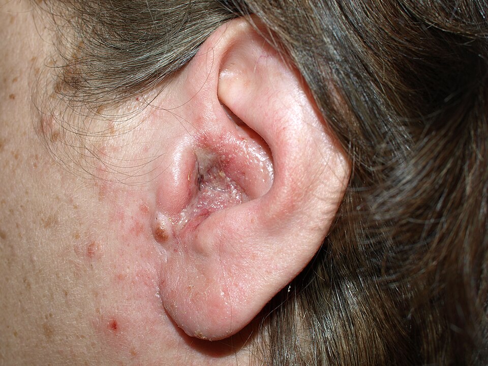 Otitis externa (swimmer's ear) — inflamed ear canal