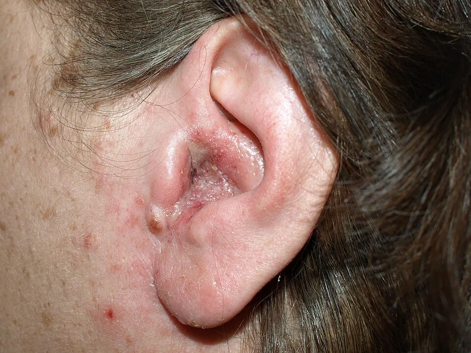 Otitis externa (swimmer's ear) — inflamed ear canal