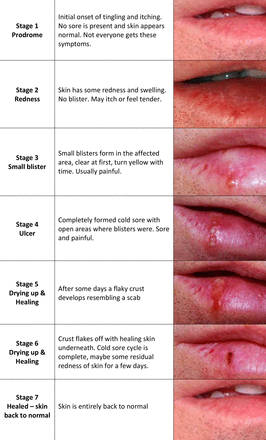 Stage 1: Prodrome — normal appearing lip
