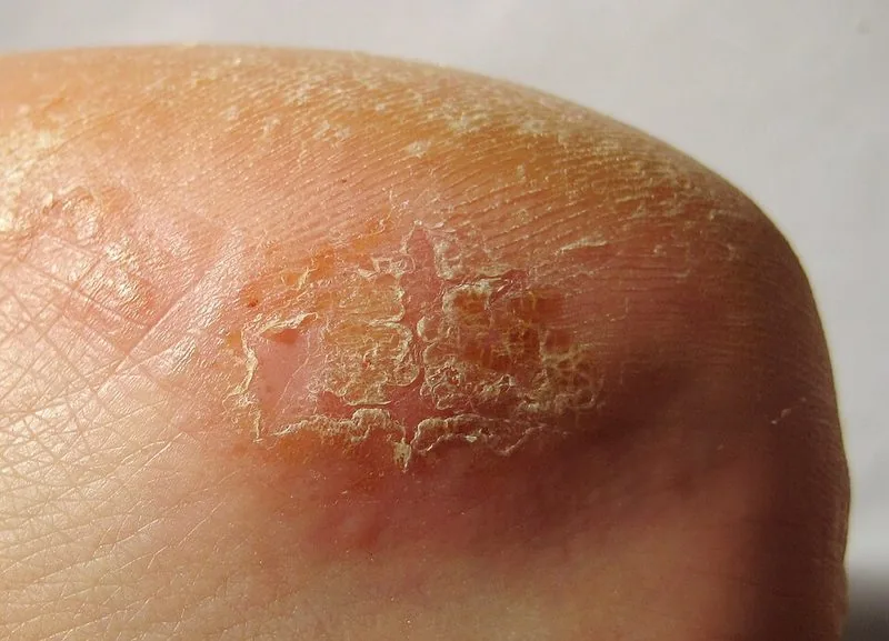 Contact dermatitis — allergic skin reaction with redness and irritation