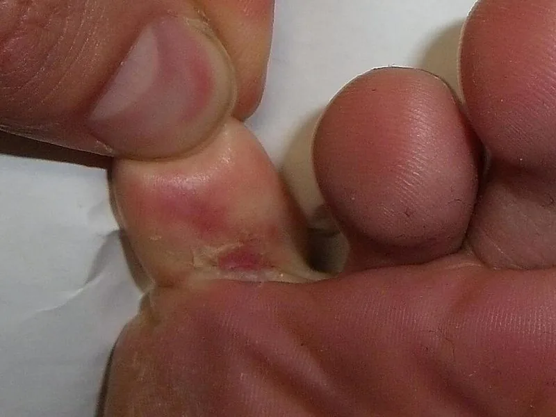 Athlete's foot (tinea pedis) — fungal infection between toes