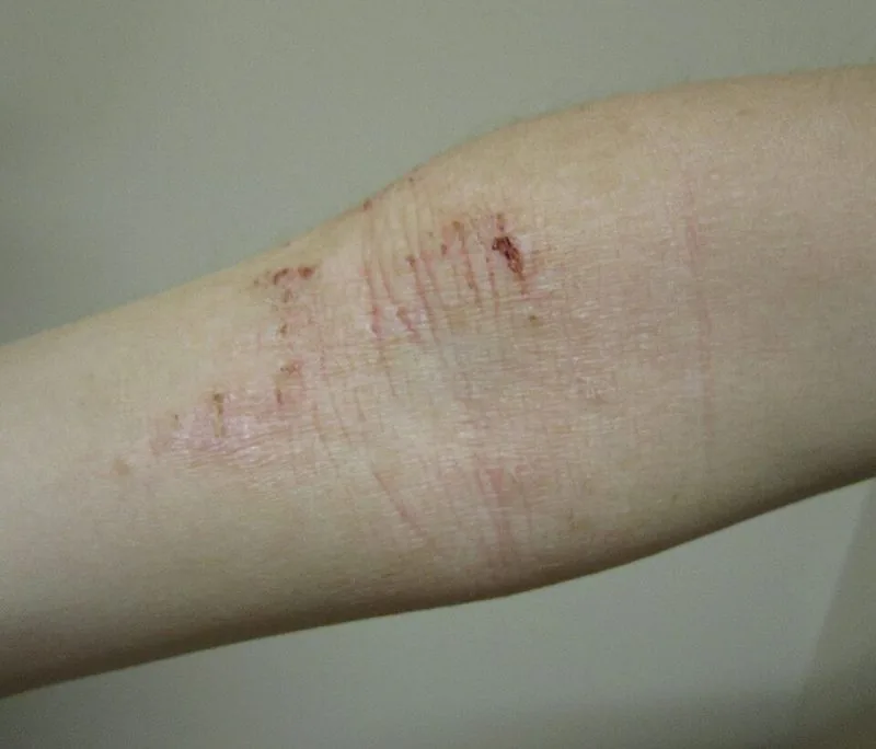 Atopic dermatitis (eczema) — inflamed irritated skin on the arm