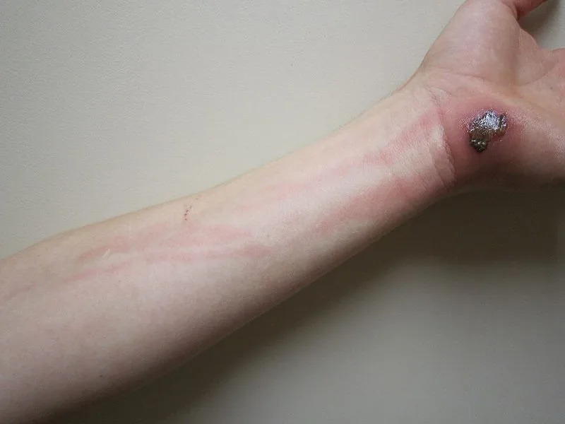 Cellulitis — red swollen warm skin from bacterial infection