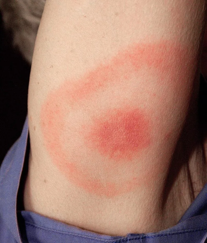 Erythema migrans — classic bullseye rash of Lyme disease with concentric red rings and central clearing after a tick bite