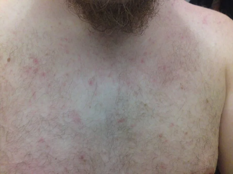 Miliaria rubra (heat rash) — small red bumps from blocked sweat ducts