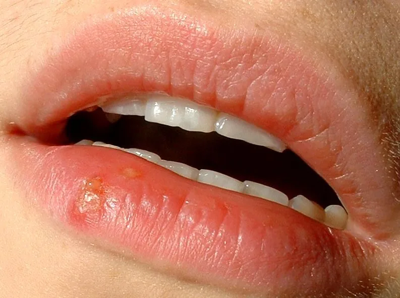 HSV-1 oral herpes — cold sore blister on the lip