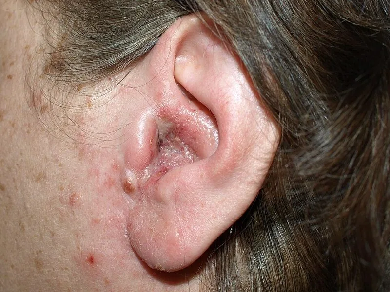 Otitis externa — inflamed ear canal from ear infection