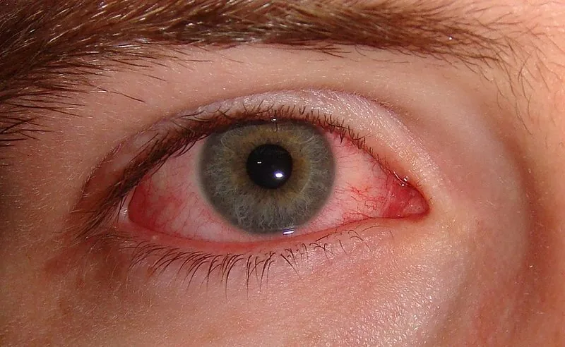 Conjunctivitis (pink eye) — red inflamed eye with discharge