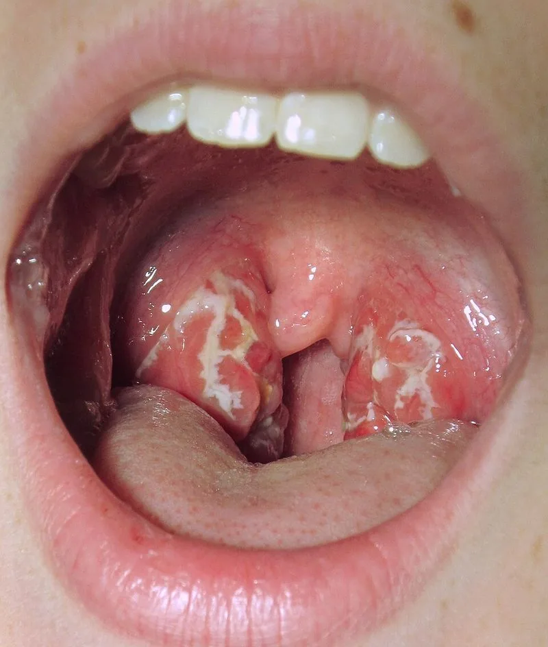 Swollen tonsils with exudate — tonsillitis evaluation and treatment