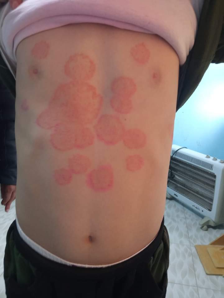 Skin rash evaluation — circular rash pattern requiring clinical assessment