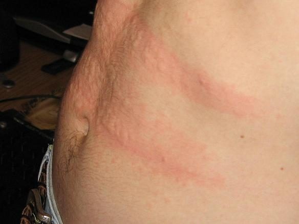 Urticaria (hives) — raised red welts on skin from allergic reaction